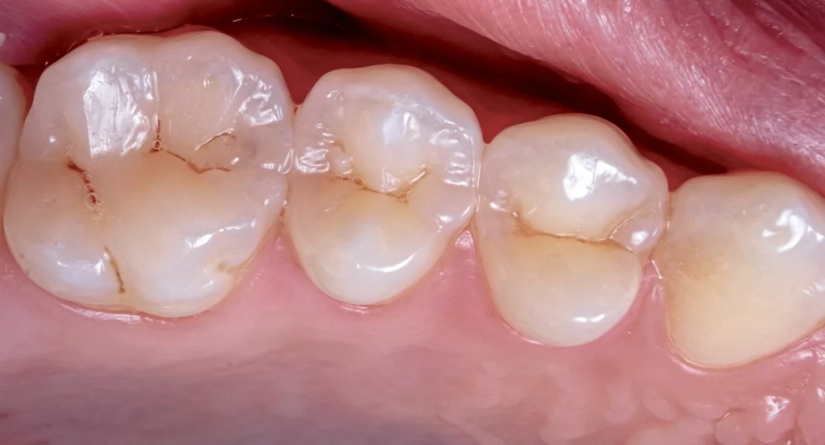 The End of the Drill? Groundbreaking Clinical Trial Paves the Way for FDA Approval of Pain-Free Cavity Treatment